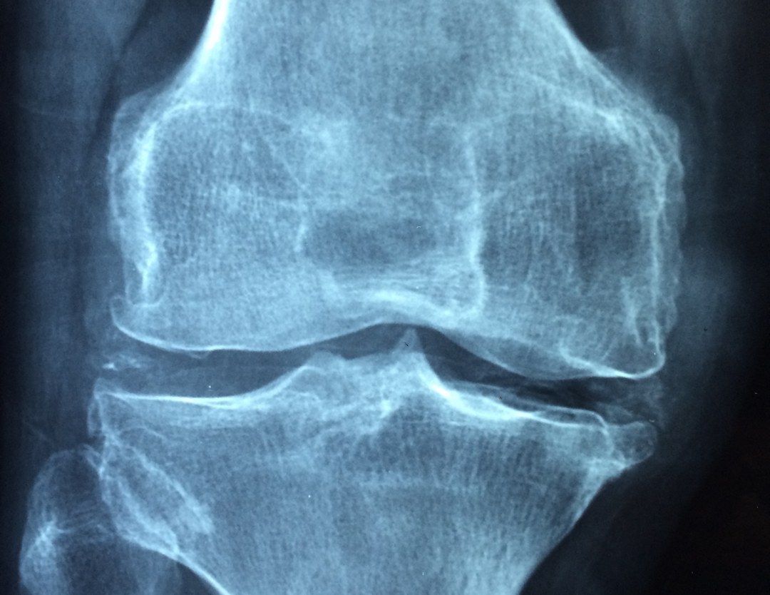 5 Nutrients Beyond Calcium that Support Women’s Bone Health